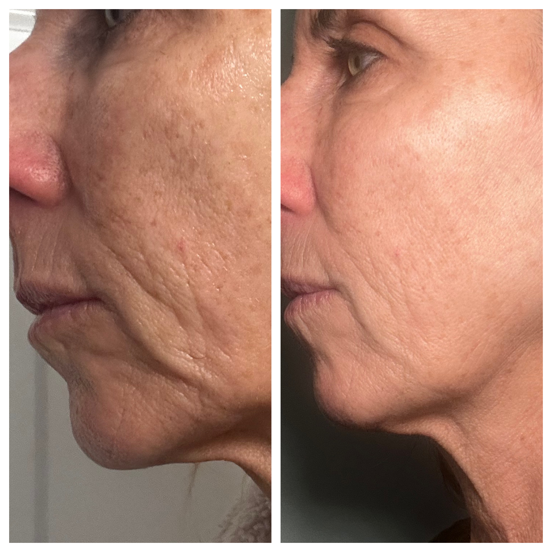 Before and after — Woman, Mid 50s, 90-day jawline and texture results