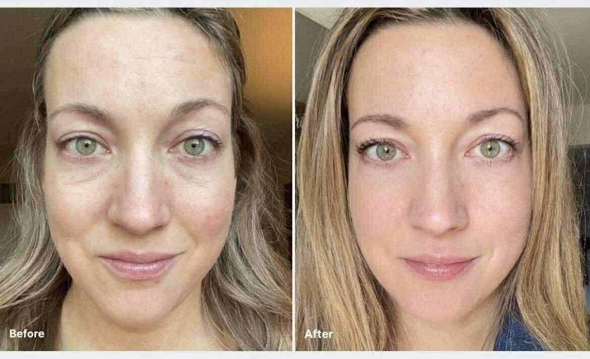 Before and after — Woman, Mid 30s, 90-day radiance and glow results