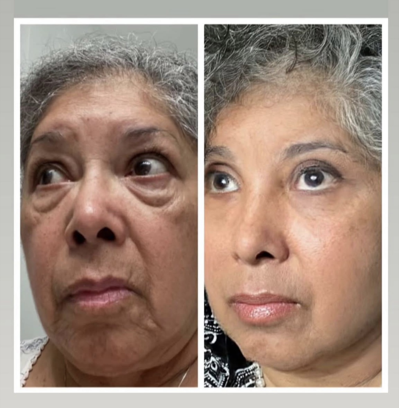 Before and after — Woman, Mid 60s, 90-day firmness and radiance results