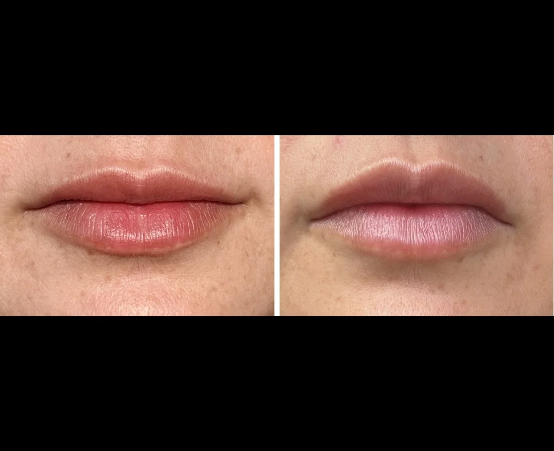 Before and after — lip fullness and definition results, woman in her 30s