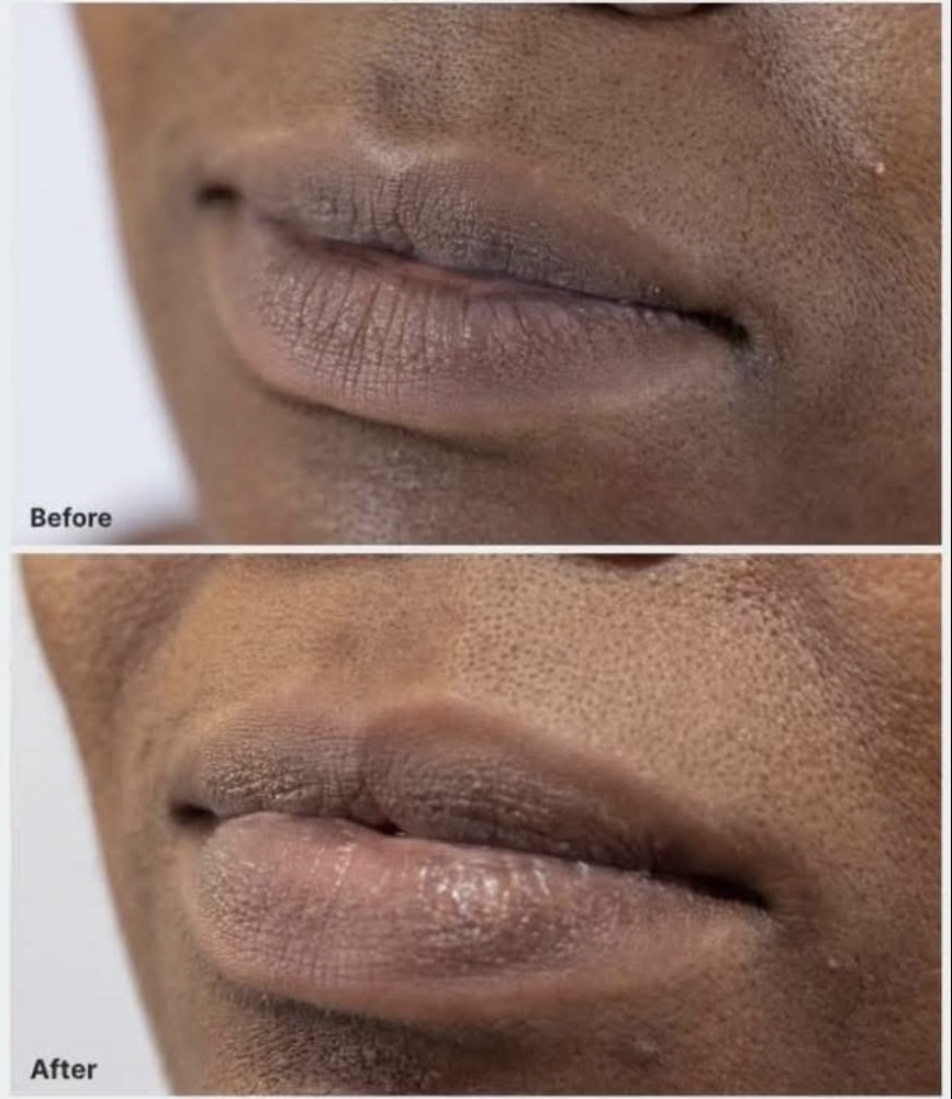Before and after — lip volume and smoothness results, profile view