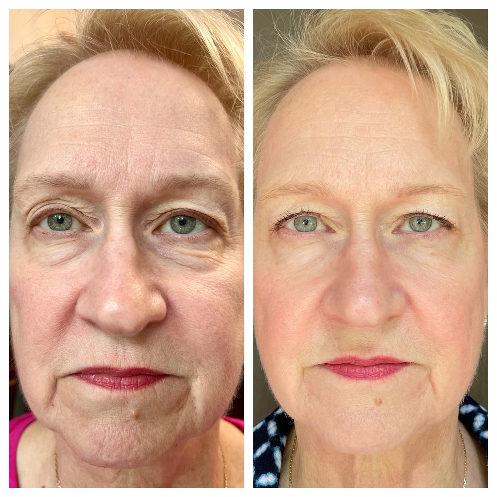 Female 60 plus before and after skin results