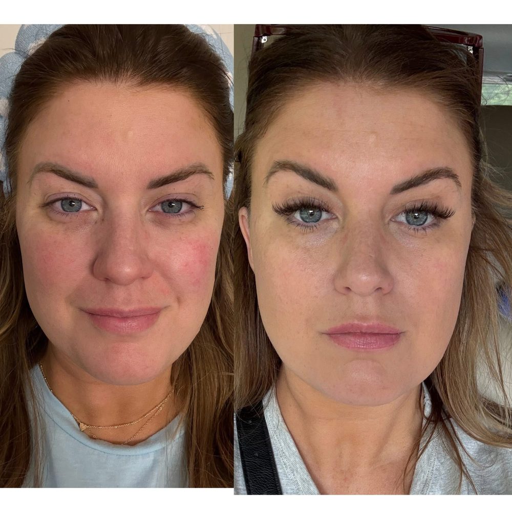 Female before and after skin results