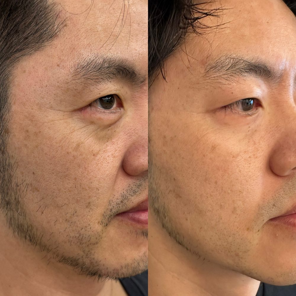 Male before and after skin results